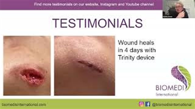 Wound Healing with Trinity